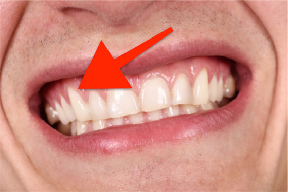 قد تدل على مشكلة صحية خطيرة.. ما أسباب حساسية اللثة وطرق علاجها؟ صورة رقم 7