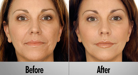 تعديل الأذن لتشبه الجنيات.. إليكم 6 عمليات تجميل مجنونة لم تسمع بها صورة رقم 4 تعديل الأذن لتشبه الجنيات.. إليكم 6 عمليات تجميل مجنونة لم تسمع بها صورة رقم 4