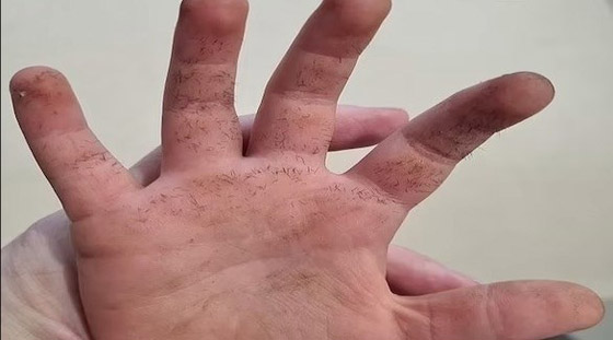 شرنقة شائكة تكاد تقتل طفلاً أثناء لعبه في حديقة المنزل صورة رقم 1