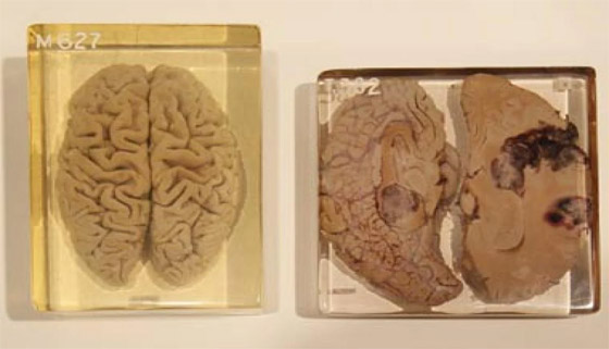 هل دماغه مختلف فعلا؟ قصة سرقة دماغ أينشتاين واللعنة التي أصابت سارقه صورة رقم 8