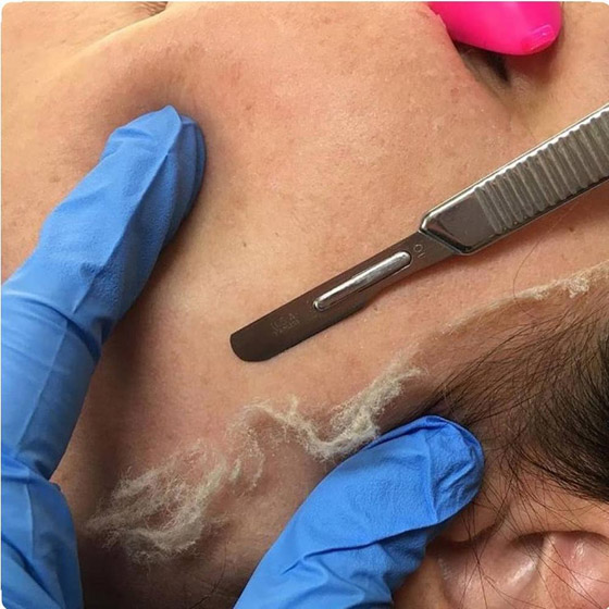 علاجات شائعة للوجه يمكن أن تضر البشرة صورة رقم 3