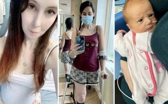 قصة أم بريطانية مصابة بالسرطان اختارت بتر ساقها على إجهاض جنينها! صورة رقم 4 قصة أم بريطانية مصابة بالسرطان اختارت بتر ساقها على إجهاض جنينها! صورة رقم 4
