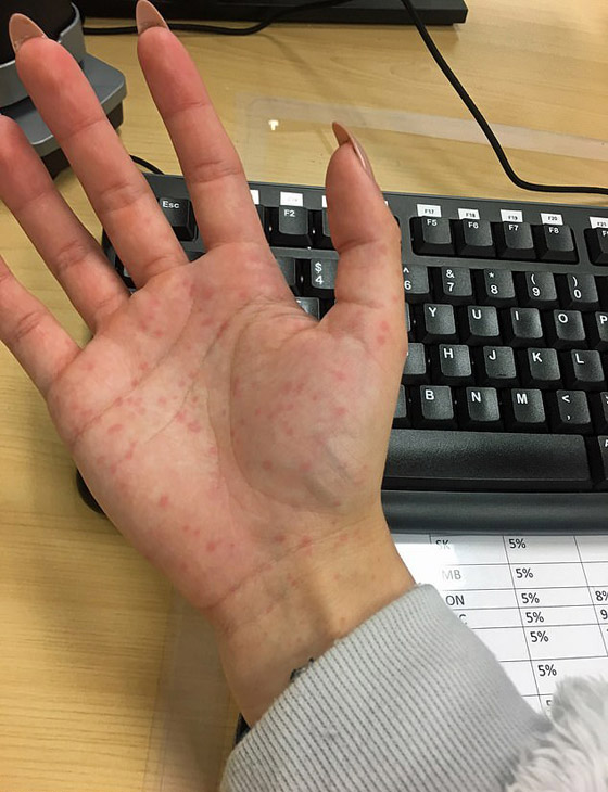 تعاني من حساسية شديدة تجاه البرد يمكن أن تتسبب بوفاتها صورة رقم 4