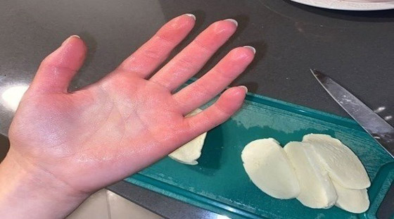 تعاني من حساسية شديدة تجاه البرد يمكن أن تتسبب بوفاتها صورة رقم 1