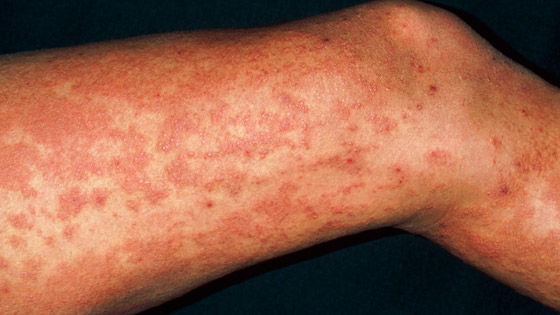 تعاني من حساسية شديدة تجاه البرد يمكن أن تتسبب بوفاتها صورة رقم 5