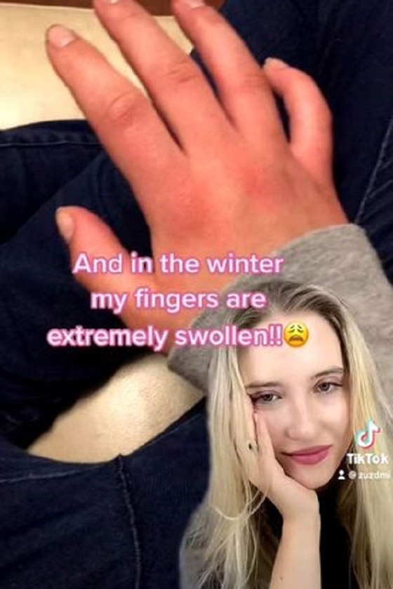 تعاني من حساسية شديدة تجاه البرد يمكن أن تتسبب بوفاتها صورة رقم 3