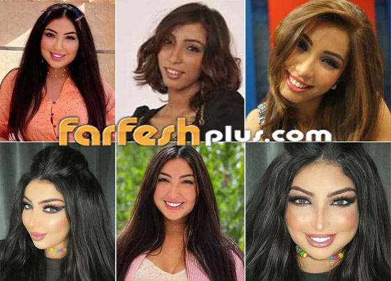 صور نجمات قبل وبعد عمليات التجميل والتغيير صادم: سوسن هارون، دنيا بطمة و صورة رقم 4 صور نجمات قبل وبعد عمليات التجميل والتغيير صادم: سوسن هارون، دنيا بطمة و صورة رقم 4