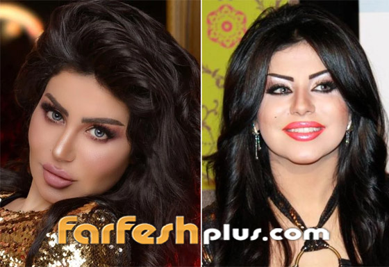 صور نجمات قبل وبعد عمليات التجميل والتغيير صادم: سوسن هارون، دنيا بطمة و صورة رقم 7 صور نجمات قبل وبعد عمليات التجميل والتغيير صادم: سوسن هارون، دنيا بطمة و صورة رقم 7