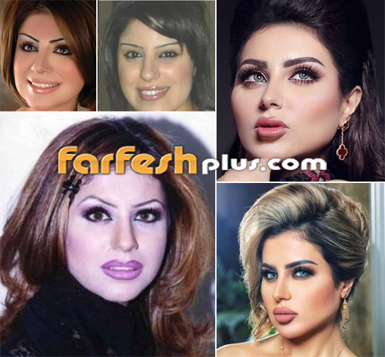 صور نجمات قبل وبعد عمليات التجميل والتغيير صادم: سوسن هارون، دنيا بطمة و صورة رقم 8 صور نجمات قبل وبعد عمليات التجميل والتغيير صادم: سوسن هارون، دنيا بطمة و صورة رقم 8