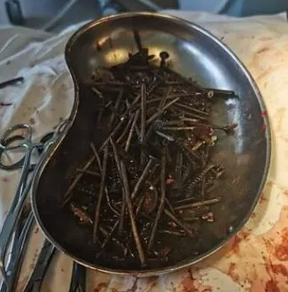 أغرب عملية جراحية.. أطباء يعثرون على مسامير وبراغي في معدة مريض! صورة رقم 1