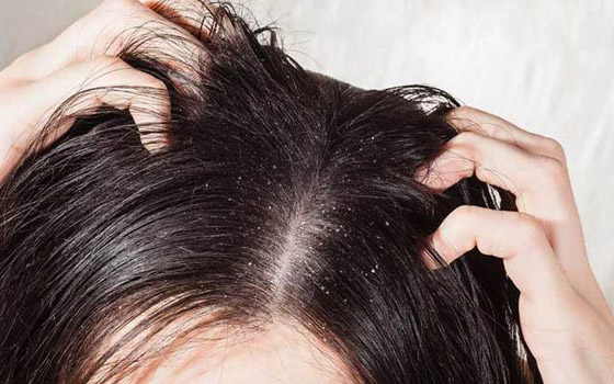 جافة أم دهنية.. أي نوع من القشرة تعانون منه؟ وما علاجها؟ صورة رقم 6