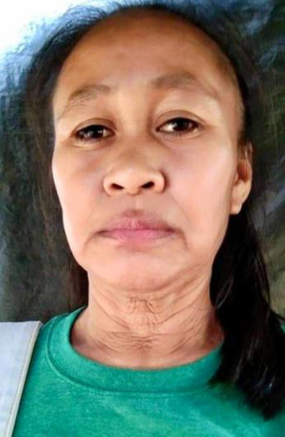 حالة نادرة.. فتاة فلبينية بعمر 16 عاما بوجه امرأة في سن الـ50! صورة رقم 11 حالة نادرة.. فتاة فلبينية بعمر 16 عاما بوجه امرأة في سن الـ50! صورة رقم 11