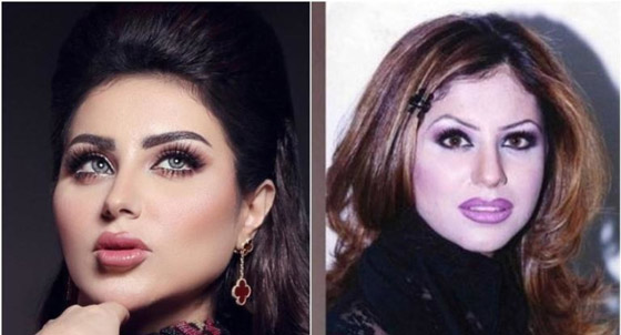 نجمات الخليج قبل وبعد التجميل  صور صادمه : صورة رقم 25