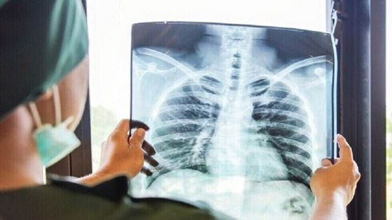 صور بالأشعة السينية تظهر الفرق بين الرئتين قبل وبعد اللقاح صورة رقم 8
