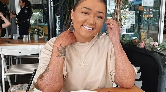 تتحول إلى عارضة أزياء رغم إصابتها بحروق صورة رقم 1