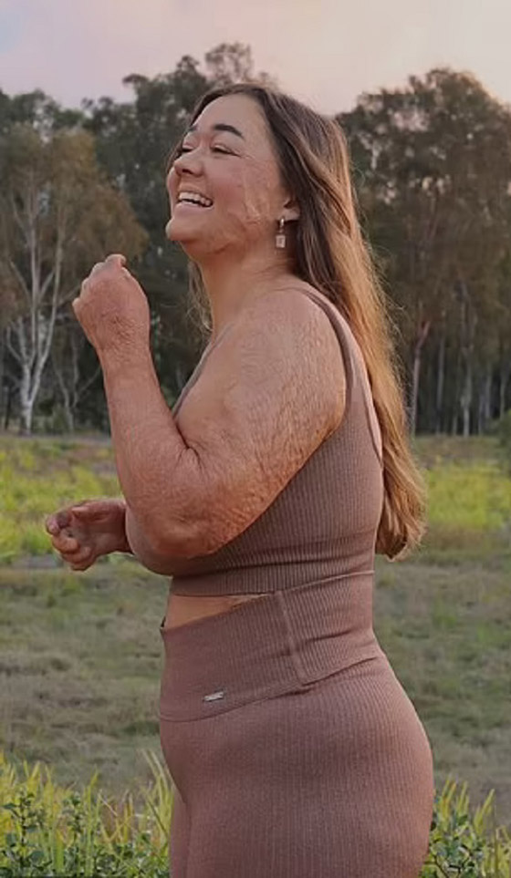 تتحول إلى عارضة أزياء رغم إصابتها بحروق صورة رقم 2