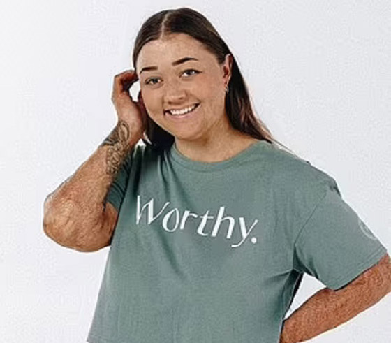 تتحول إلى عارضة أزياء رغم إصابتها بحروق صورة رقم 3