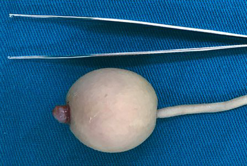 حالة نادرة.. ولادة طفل بذيل بشرى 12 سم فى البرازيل صورة رقم 3 حالة نادرة.. ولادة طفل بذيل بشرى 12 سم فى البرازيل صورة رقم 3