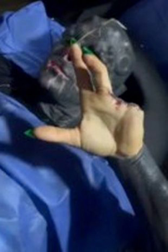 صور صادمة: شاب يشوه وجهه ويقطع أصابعه ليشبه الكائنات الفضائية! صورة رقم 6