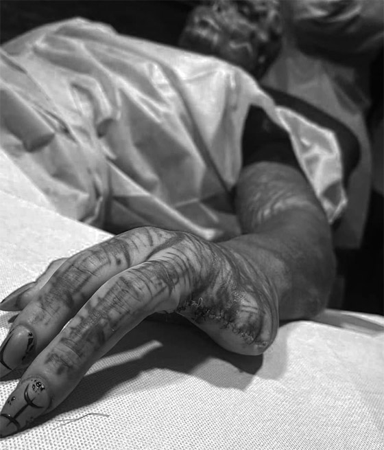 صور صادمة: شاب يشوه وجهه ويقطع أصابعه ليشبه الكائنات الفضائية! صورة رقم 4