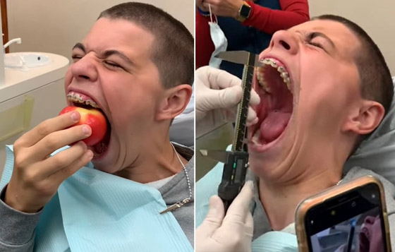 فيديو وصور: أمريكي يدخل موسوعة غينيس لامتلاكه أكبر فم في العالم صورة رقم 14 فيديو وصور: أمريكي يدخل موسوعة غينيس لامتلاكه أكبر فم في العالم صورة رقم 14