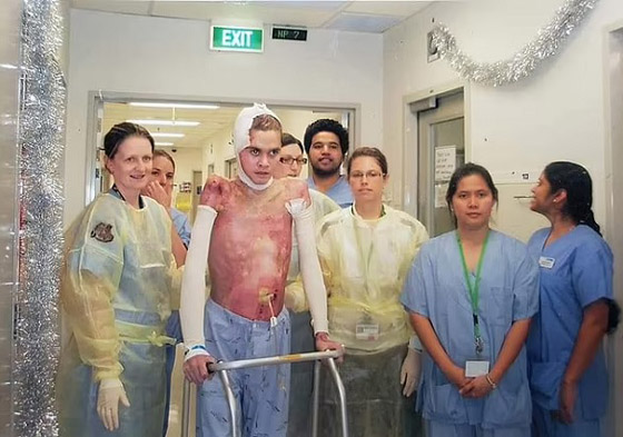 يتعافى بأعجوبة من صدمتين كهربائتين عنيفتين صورة رقم 2