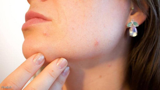 لبشرة خالية من حب الشباب.. تجنبوا تناول هذه الأطعمة صورة رقم 1