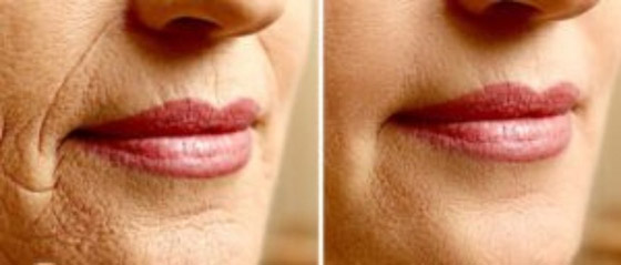 قبل البوتوكس.... نصائح لتخفيف التجاعيد حول الفم صورة رقم 2