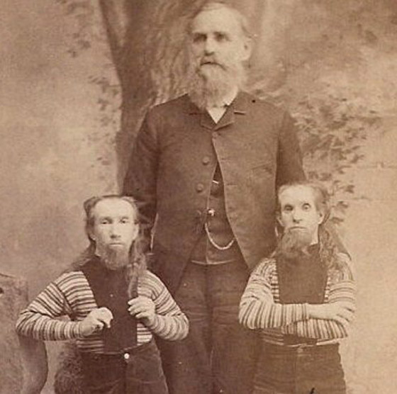 9 نجوم لسيرك (بارنوم) اشتهروا بسماتهم الغريبة: رجل بـ3 أرجل وامرأة ملتحية صورة رقم 6