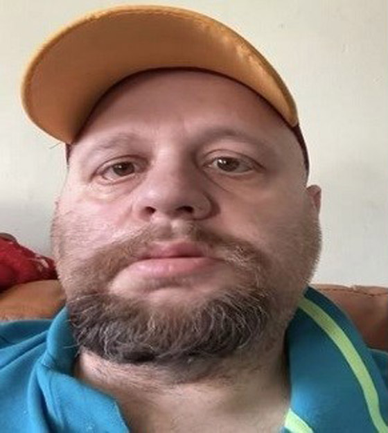 يضطر لإغلاق عينيه بشريط لاصق بسبب حالة نادرة صورة رقم 2