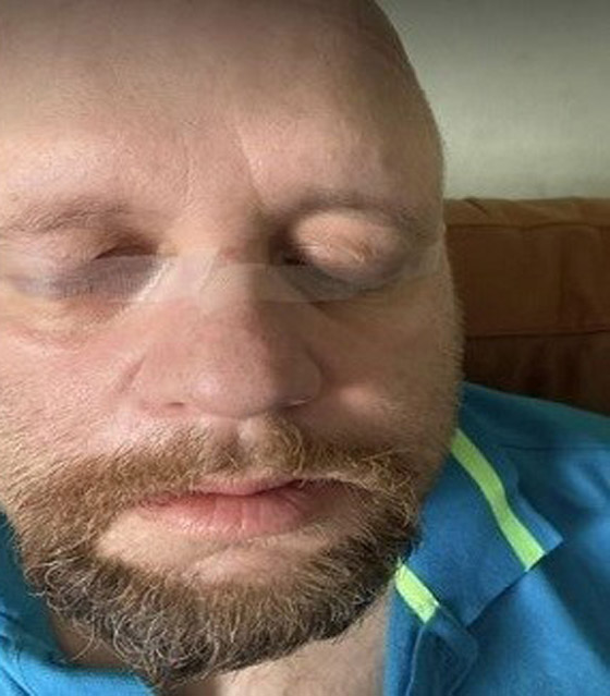 يضطر لإغلاق عينيه بشريط لاصق بسبب حالة نادرة صورة رقم 1