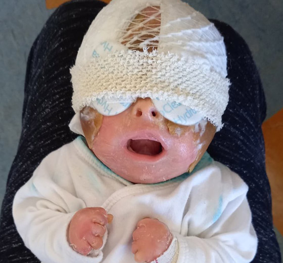 وُلدت بجلد قوقعة السلحفاة! طفلة هزمت توقعات الأطباء بموتها بمرض نادر صورة رقم 1