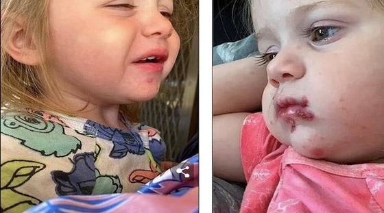 طفلة تعاني من التهابات شديدة حول فمها بسبب قبلة صورة رقم 1