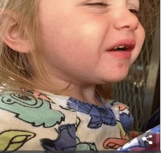 طفلة تعاني من التهابات شديدة حول فمها بسبب قبلة صورة رقم 4