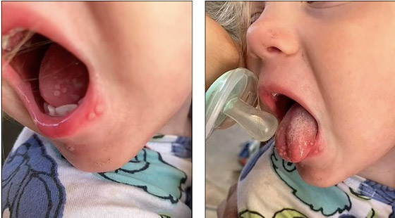 طفلة تعاني من التهابات شديدة حول فمها بسبب قبلة صورة رقم 3