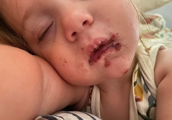طفلة تعاني من التهابات شديدة حول فمها بسبب قبلة صورة رقم 2