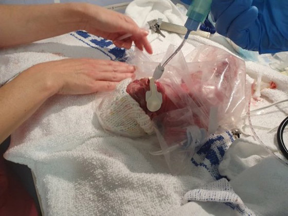 طفلة ولدت في الشهر الخامس من الحمل تحتفل بعيد ميلادها الأول صورة رقم 1