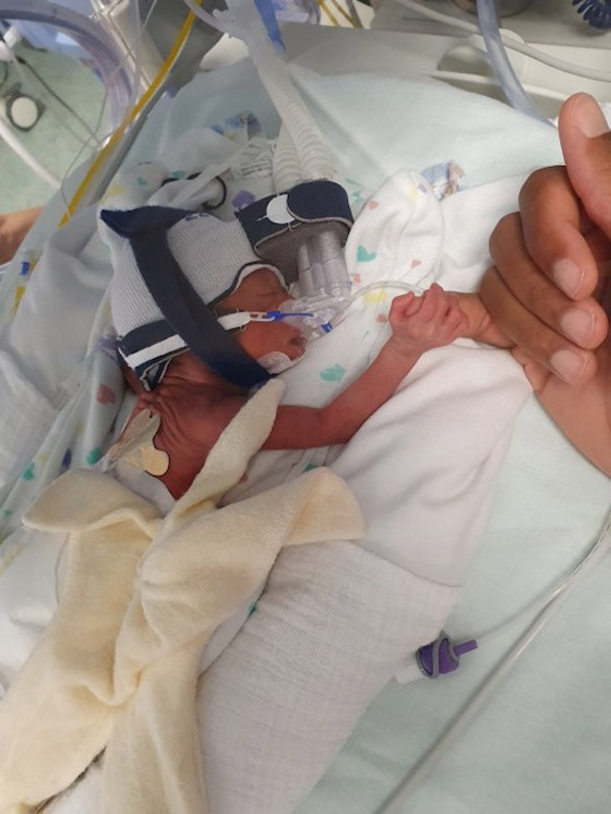 طفلة ولدت في الشهر الخامس من الحمل تحتفل بعيد ميلادها الأول صورة رقم 2