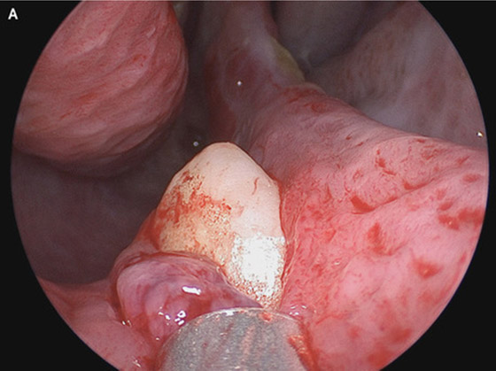 بعد سنوات من صعوبة التنفس.. مريض يكتشف نمو سن داخل أنفه! صور صورة رقم 2