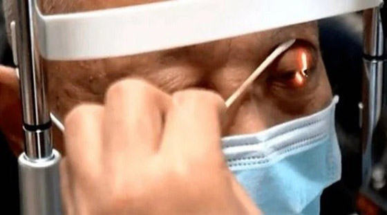 بسبب حالة نادرة... يذرف الدموع كلما تناول الطعام صورة رقم 1