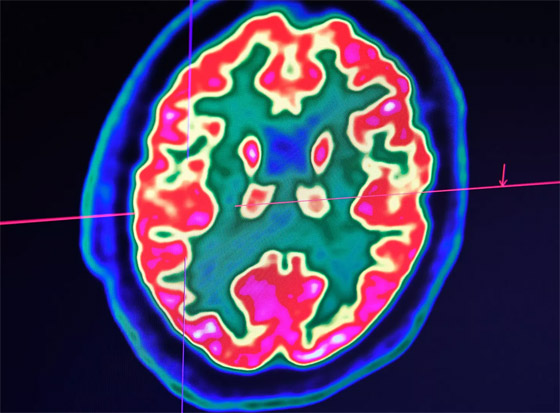 شريحة بالدماغ: أطباء ينجحون بإعادة قدرة الكلام لمريض بالشلل الكلي! صورة رقم 2