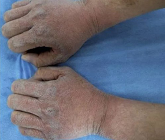 بقع سميكة ومنتفخة.. شاب يصاب بمرض جلدي نادر كلما لمس الماء! صورة رقم 3