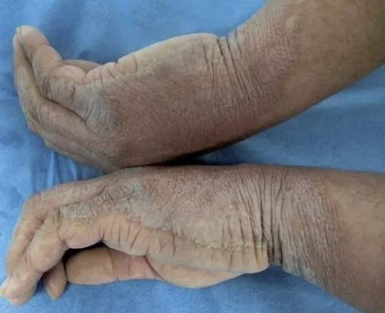 بقع سميكة ومنتفخة.. شاب يصاب بمرض جلدي نادر كلما لمس الماء! صورة رقم 4