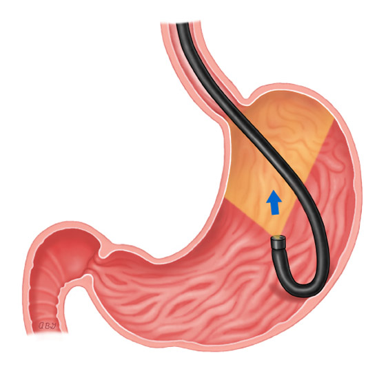 خبر سار.. تقنية غير جراحية لعلاج السمنة بالليزر صورة رقم 1