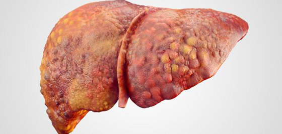 أخطر 10 أمراض في العالم صورة رقم 10 أخطر 10 أمراض في العالم صورة رقم 10