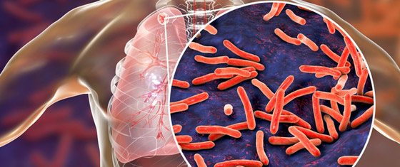 أخطر 10 أمراض في العالم صورة رقم 9 أخطر 10 أمراض في العالم صورة رقم 9