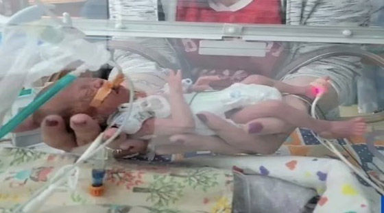 نجاة طفلة من الموت ولدت بمريء منفصل بفضل جراحة رائدة صورة رقم 1