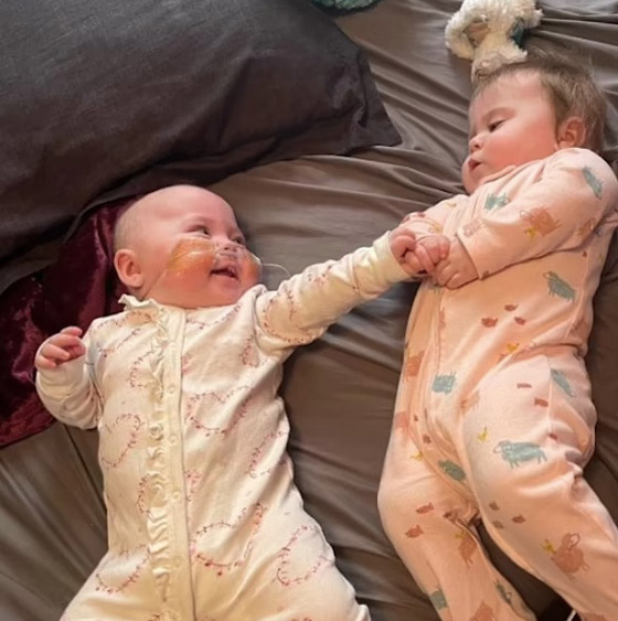 نجاة طفلة من الموت ولدت بمريء منفصل بفضل جراحة رائدة صورة رقم 2