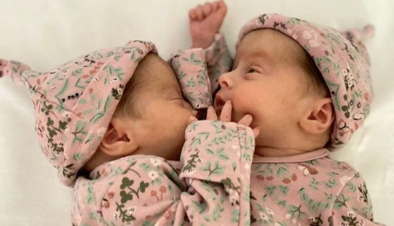 فيديو وصور توأم ملتصق.. معجزة وحالة نادرة! ماذا يقول الوالدان وهل ستتم عملية الفصل؟ صورة رقم 3 فيديو وصور توأم ملتصق.. معجزة وحالة نادرة! ماذا يقول الوالدان وهل ستتم عملية الفصل؟ صورة رقم 3