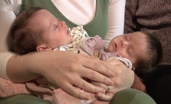 فيديو وصور توأم ملتصق.. معجزة وحالة نادرة! ماذا يقول الوالدان وهل ستتم عملية الفصل؟ صورة رقم 4 فيديو وصور توأم ملتصق.. معجزة وحالة نادرة! ماذا يقول الوالدان وهل ستتم عملية الفصل؟ صورة رقم 4